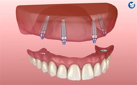 dental implants in phnom penh cambodia|Dental Implants in Phnom Penh, Cambodia.